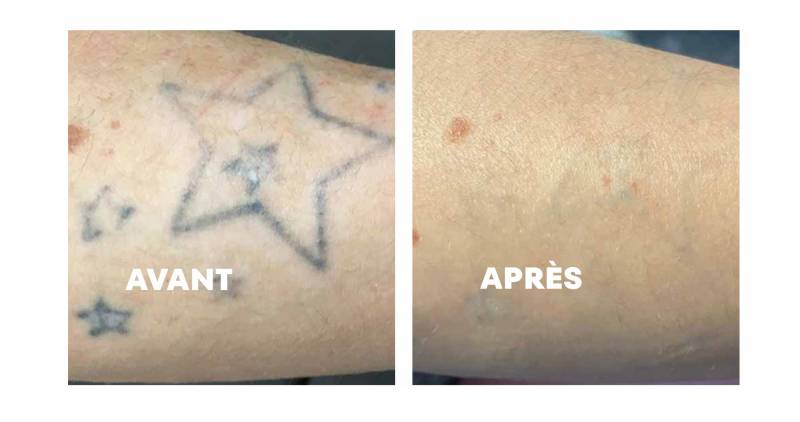 5 avantages du laser picoseconde pour effacer un tatouage en toute sécurité