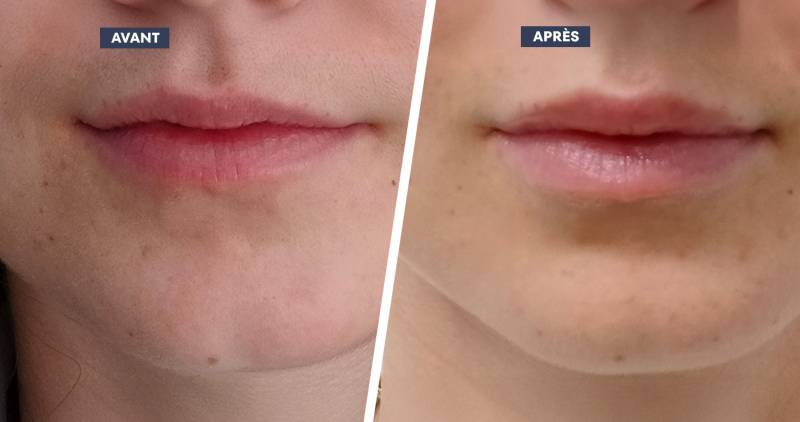 injection levres aix en provence asymetrie