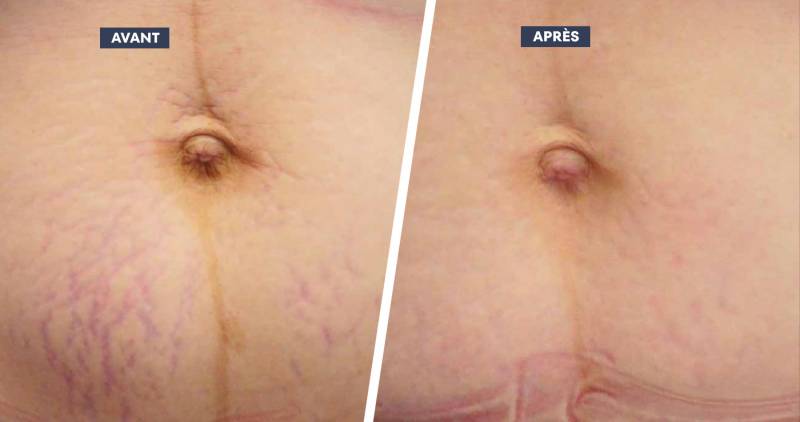 Laser ProDeep Corps à Aix-en-Provence : relachement cutané, cicatrices, vergetures