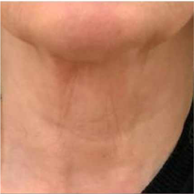 Lifting du cou sans chirurgie à Aix-en-Provence