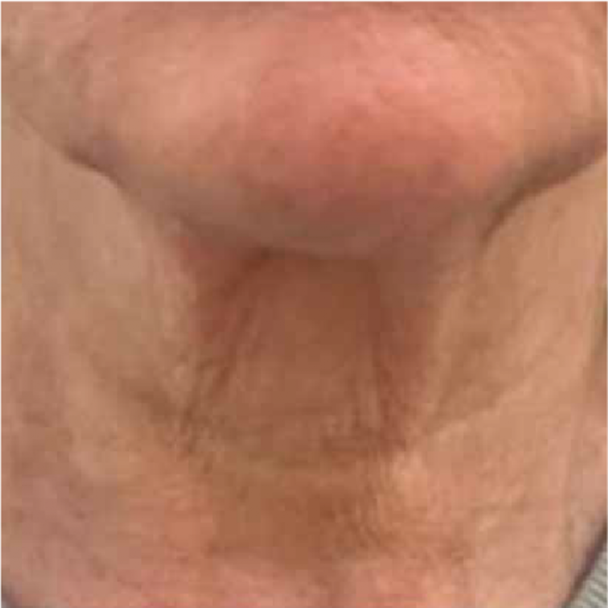 Lifting du cou sans chirurgie à Aix-en-Provence