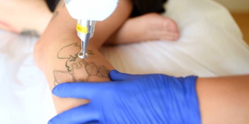 laser detatouage aix en provence