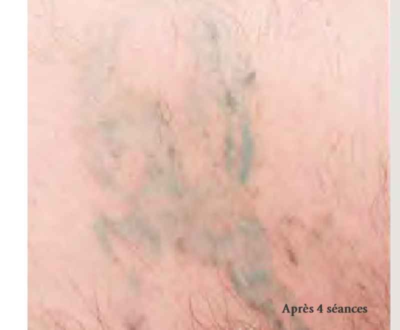 Détatouage laser à Aix-en-Provence séances efficaces et peau respectée