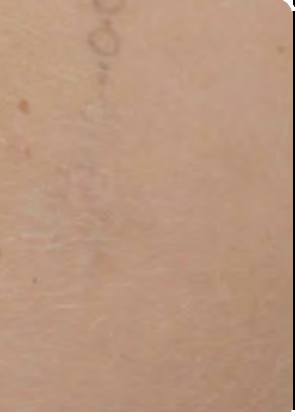 Détatouage laser picoseconde à Aix-en-Provence plus rapide, plus efficace