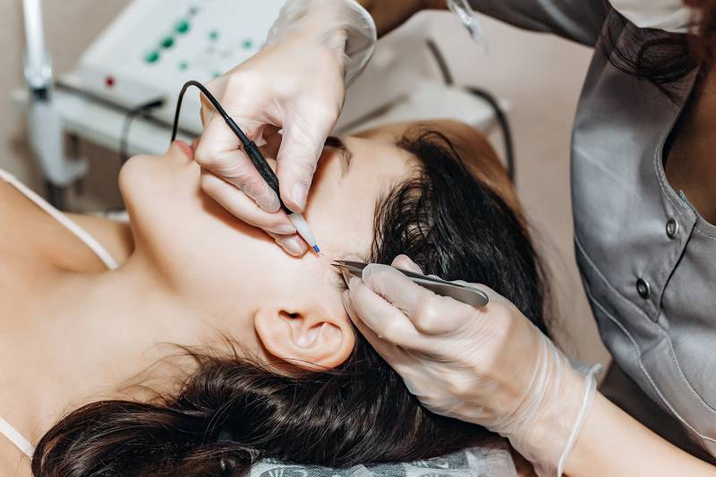 EPILATION DÉFINITIVE ÉLECTRIQUE OU ÉLECTROLYSE : L'ALTERNATIVE À L'ÉPILATION LASER