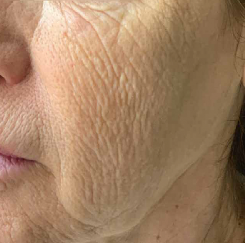 Laser fraxel rajeunissement visage à Aix-en-Provence